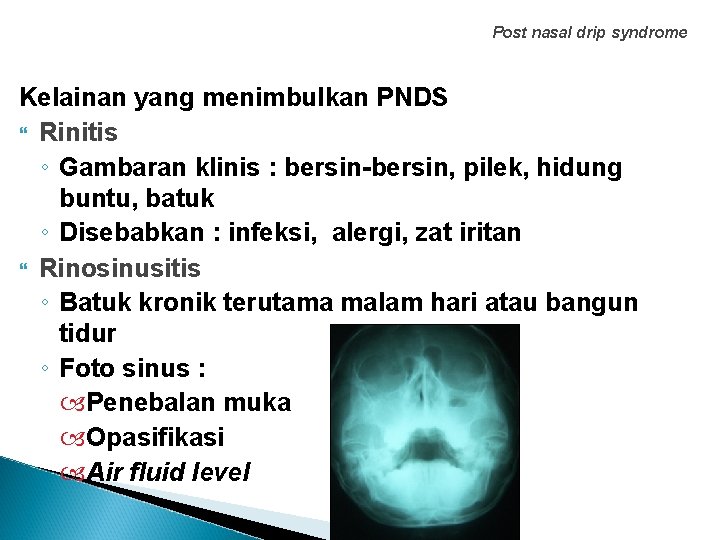 Post nasal drip syndrome Kelainan yang menimbulkan PNDS Rinitis ◦ Gambaran klinis : bersin-bersin,