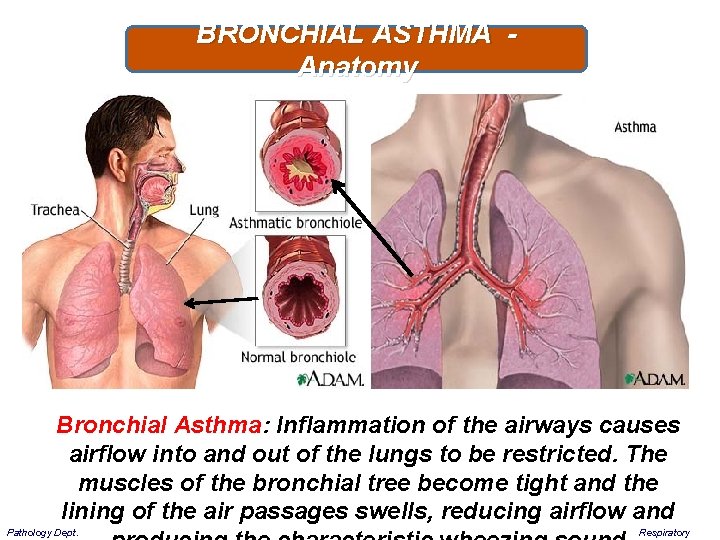 BRONCHIAL ASTHMA - Anatomy Bronchial Asthma: Inflammation of the airways causes airflow into and