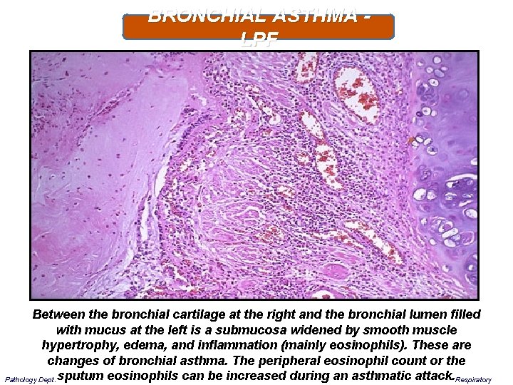 BRONCHIAL ASTHMA - LPF Between the bronchial cartilage at the right and the bronchial
