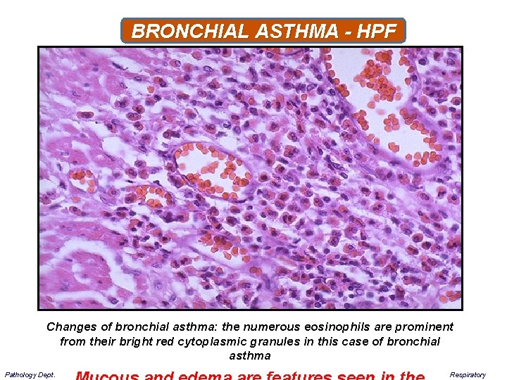 BRONCHIAL ASTHMA - HPF Changes of bronchial asthma: the numerous eosinophils are prominent from