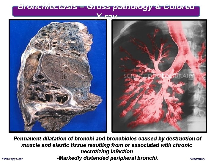 Bronchiectasis – Gross pathology & Colored X-ray Permanent dilatation of bronchi and bronchioles caused