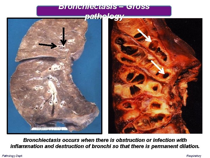 Bronchiectasis – Gross pathology Bronchiectasis occurs when there is obstruction or infection with inflammation