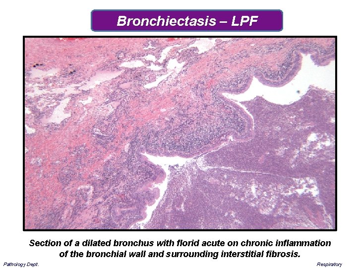Bronchiectasis – LPF Section of a dilated bronchus with florid acute on chronic inflammation