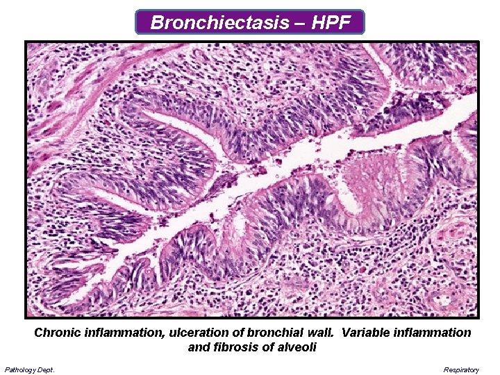Bronchiectasis – HPF Chronic inflammation, ulceration of bronchial wall. Variable inflammation and fibrosis of