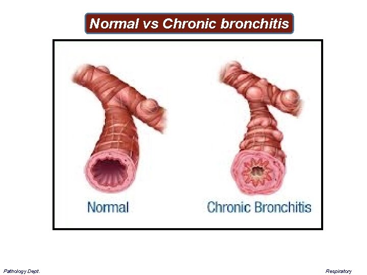 Normal vs Chronic bronchitis Pathology Dept. Respiratory 
