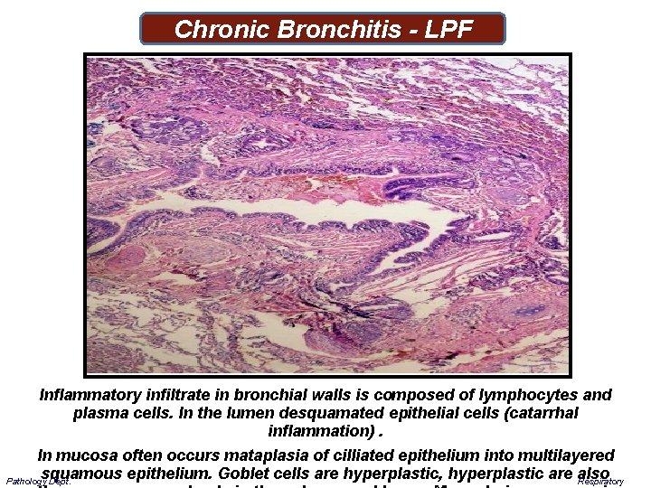 Chronic Bronchitis - LPF Inflammatory infiltrate in bronchial walls is composed of lymphocytes and