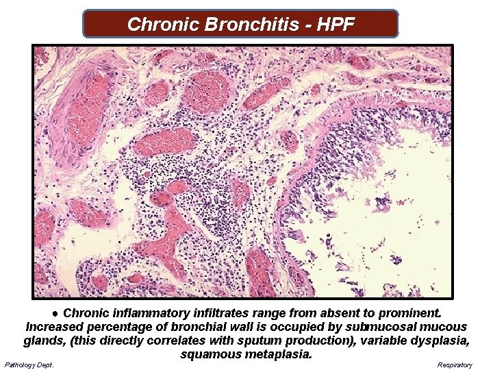 Chronic Bronchitis - HPF ● Chronic inflammatory infiltrates range from absent to prominent. Increased