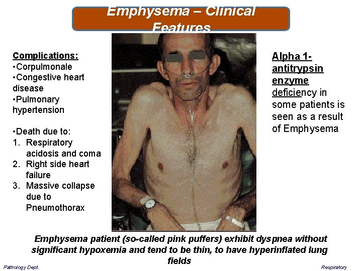 Emphysema – Clinical Features Complications: • Corpulmonale • Congestive heart disease • Pulmonary hypertension