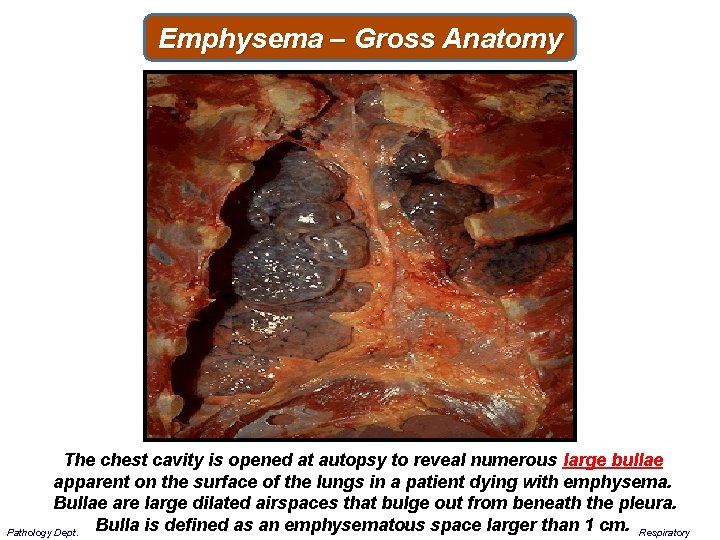 Emphysema – Gross Anatomy The chest cavity is opened at autopsy to reveal numerous