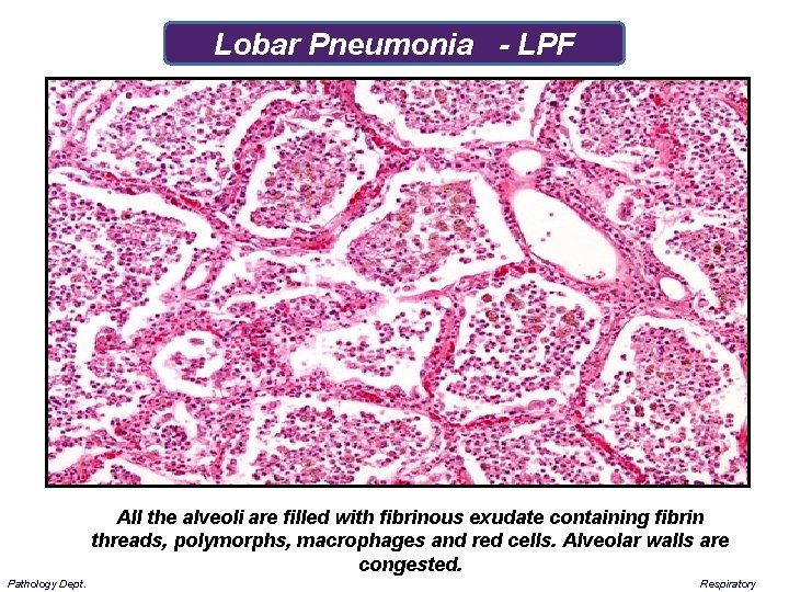 Lobar Pneumonia - LPF All the alveoli are filled with fibrinous exudate containing fibrin