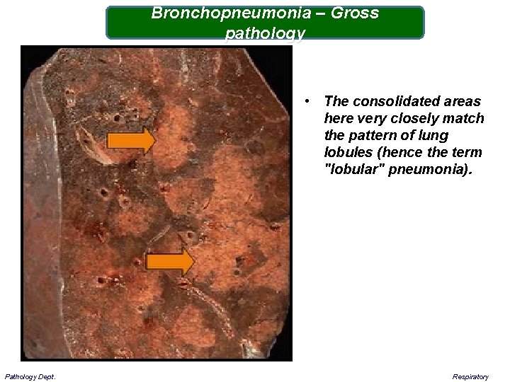 Bronchopneumonia – Gross pathology • The consolidated areas here very closely match the pattern