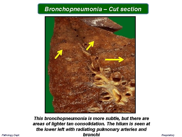 Bronchopneumonia – Cut section Pathology Dept. This bronchopneumonia is more subtle, but there areas