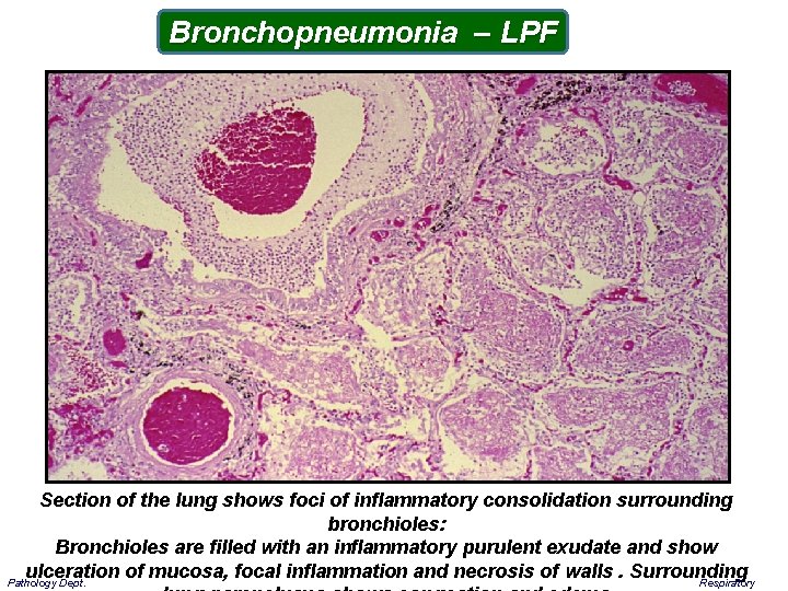Bronchopneumonia – LPF Section of the lung shows foci of inflammatory consolidation surrounding bronchioles: