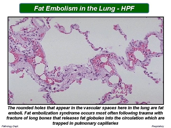 Fat Embolism in the Lung - HPF The rounded holes that appear in the