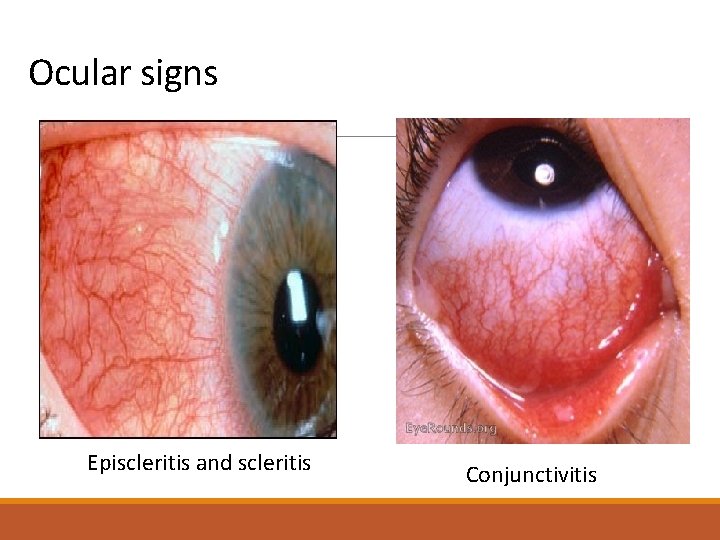 Ocular signs Episcleritis and scleritis Conjunctivitis 