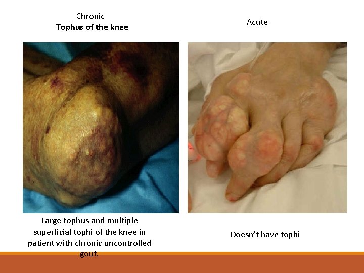 Chronic Tophus of the knee Large tophus and multiple superficial tophi of the knee