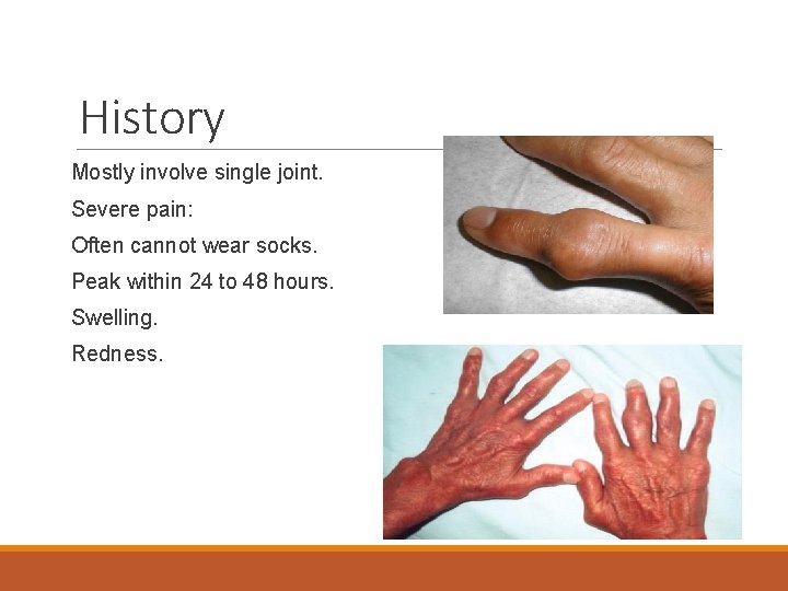 History Mostly involve single joint. Severe pain: Often cannot wear socks. Peak within 24