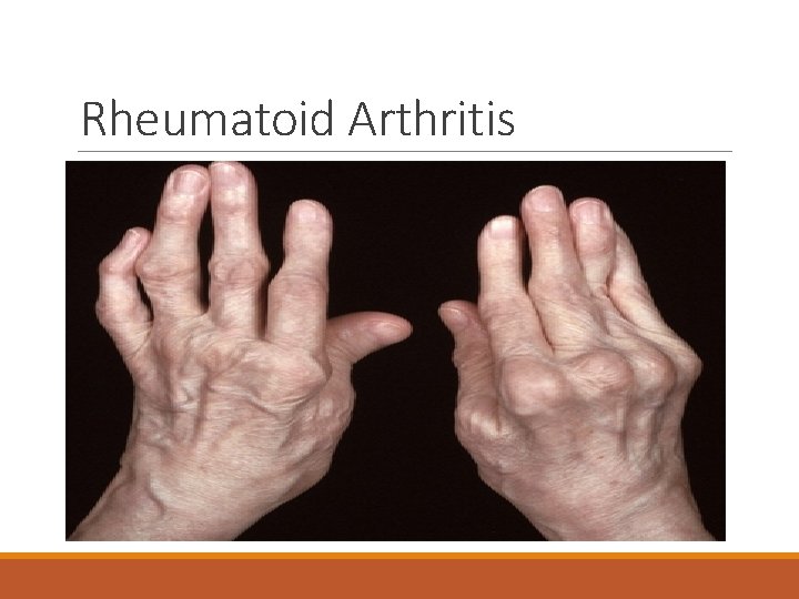 Rheumatoid Arthritis 