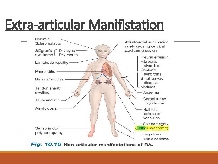 Extra-articular Manifistation 