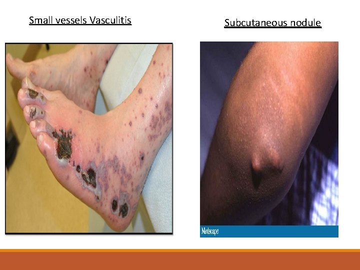 Small vessels Vasculitis Subcutaneous nodule 