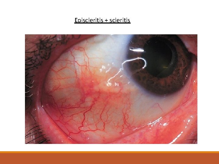 Episcleritis + scleritis 