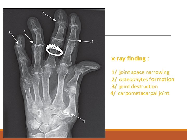 x-ray finding : 1/ joint space narrowing 2/ osteophytes formation 3/ joint destruction 4/