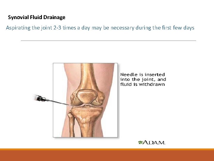  Synovial Fluid Drainage Aspirating the joint 2 -3 times a day may be