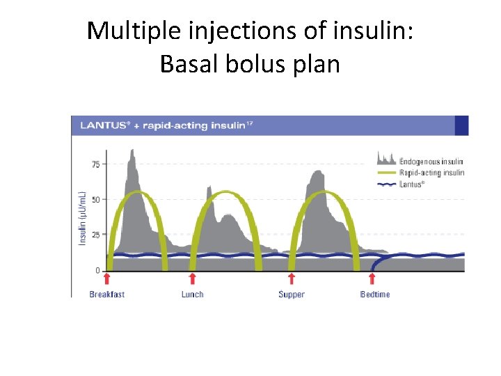 Multiple injections of insulin: Basal bolus plan 