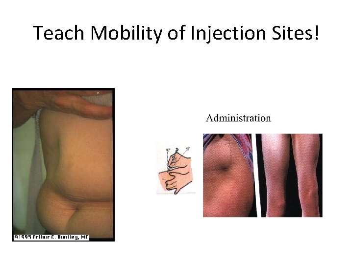 Teach Mobility of Injection Sites! 