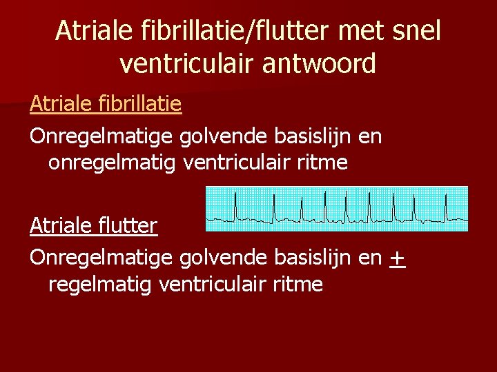 Atriale fibrillatie/flutter met snel ventriculair antwoord Atriale fibrillatie Onregelmatige golvende basislijn en onregelmatig ventriculair