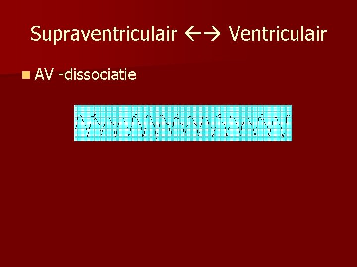 Supraventriculair Ventriculair n AV -dissociatie 