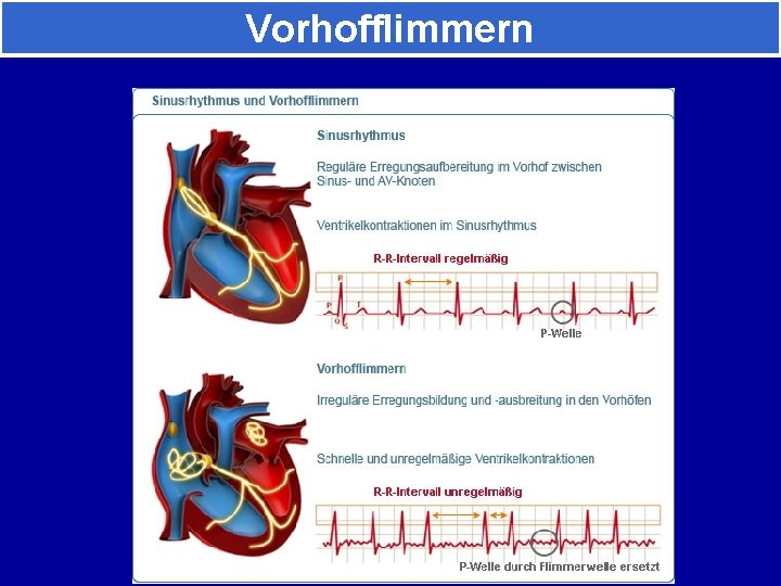 Vorhofflimmern 