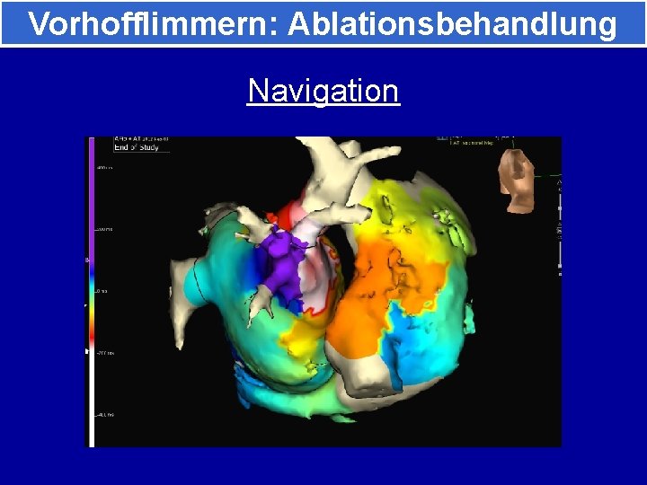 Vorhofflimmern: Ablationsbehandlung Navigation 