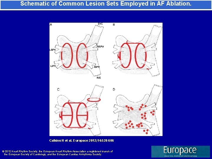 Schematic of Common Lesion Sets Employed in AF Ablation. Calkins H et al. Europace