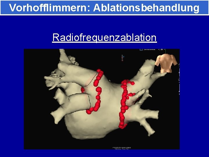 Vorhofflimmern: Ablationsbehandlung Radiofrequenzablation 