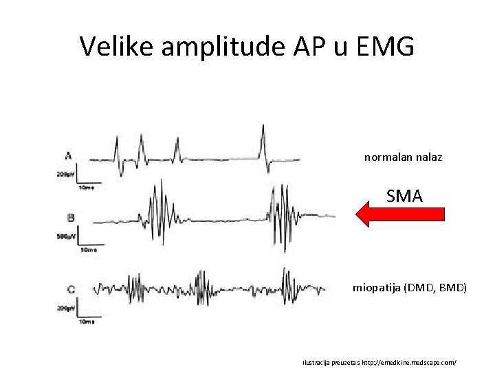 Velike amplitude AP u EMG normalan nalaz SMA miopatija (DMD, BMD) Ilustracija preuzeta s