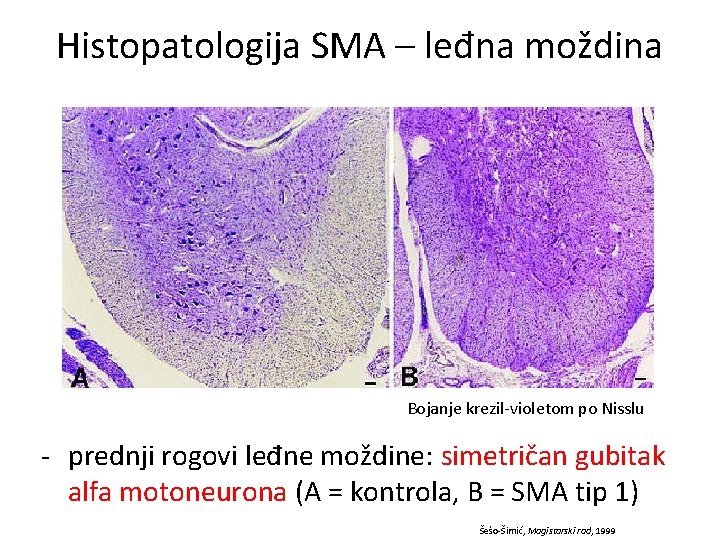 Histopatologija SMA – leđna moždina Bojanje krezil-violetom po Nisslu - prednji rogovi leđne moždine: