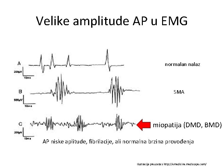 Velike amplitude AP u EMG normalan nalaz SMA miopatija (DMD, BMD) AP niske aplitude,