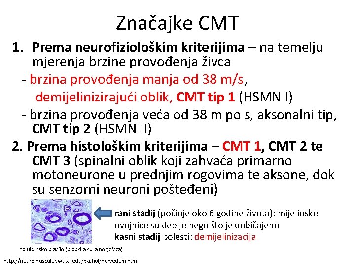 Značajke CMT 1. Prema neurofiziološkim kriterijima – na temelju mjerenja brzine provođenja živca -