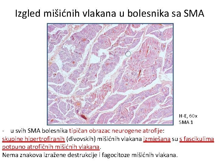 Izgled mišićnih vlakana u bolesnika sa SMA H-E, 60 x SMA 1 - u