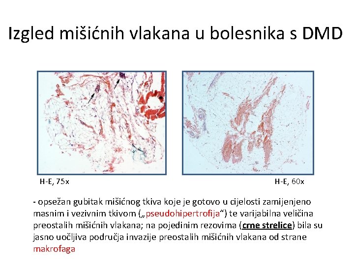 Izgled mišićnih vlakana u bolesnika s DMD H-E, 75 x H-E, 60 x -