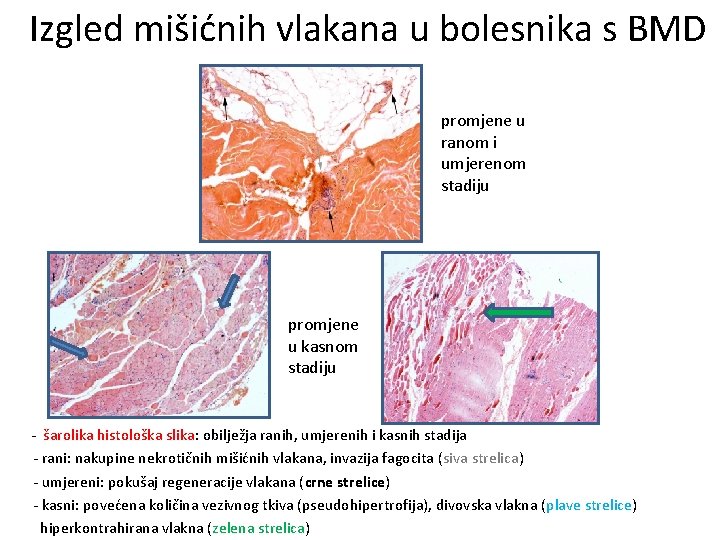Izgled mišićnih vlakana u bolesnika s BMD promjene u ranom i umjerenom stadiju promjene