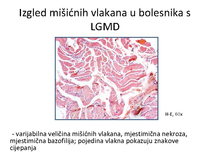 Izgled mišićnih vlakana u bolesnika s LGMD H-E, 60 x - varijabilna veličina mišićnih