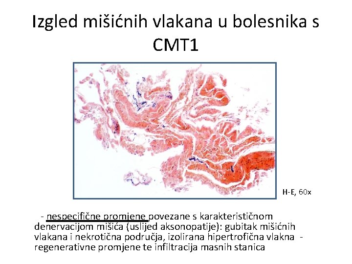 Izgled mišićnih vlakana u bolesnika s CMT 1 H-E, 60 x - nespecifične promjene