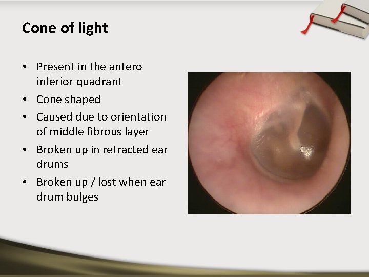 Cone of light • Present in the antero inferior quadrant • Cone shaped •