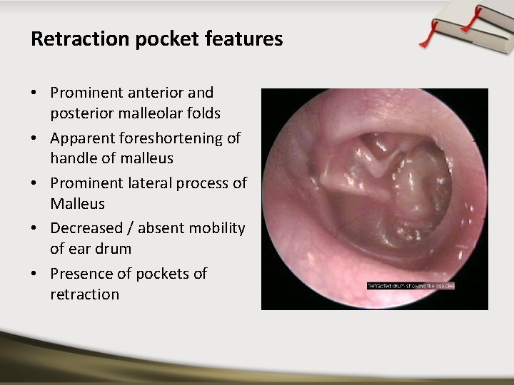 Retraction pocket features • Prominent anterior and posterior malleolar folds • Apparent foreshortening of