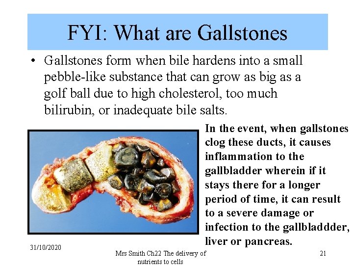 FYI: What are Gallstones • Gallstones form when bile hardens into a small pebble-like