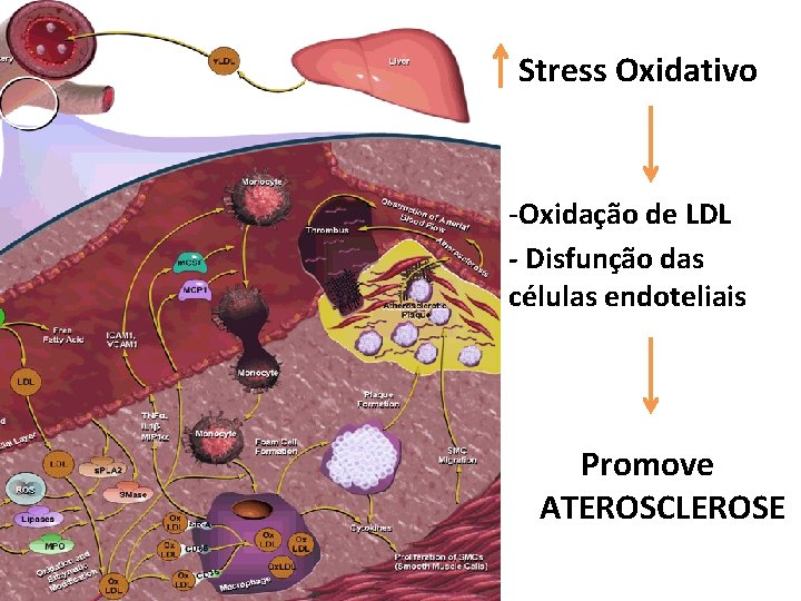 Stress Oxidativo -Oxidação de LDL - Disfunção das células endoteliais Promove ATEROSCLEROSE 