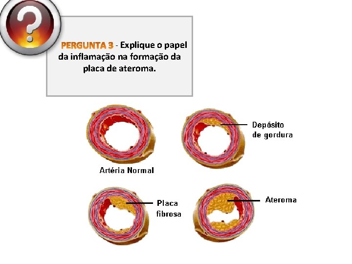 - Explique o papel da inflamação na formação da placa de ateroma. 