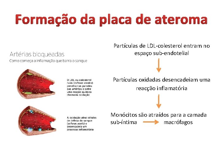 Formação da placa de ateroma Partículas de LDL-colesterol entram no espaço sub-endotelial Partículas oxidadas